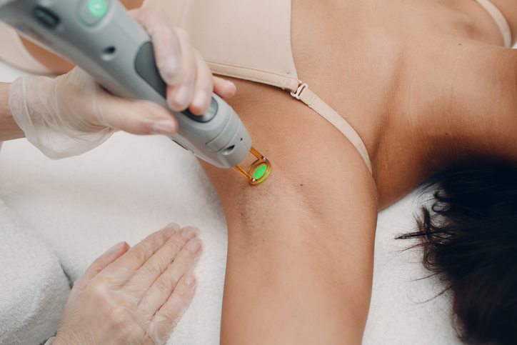 laser hair removal treatment