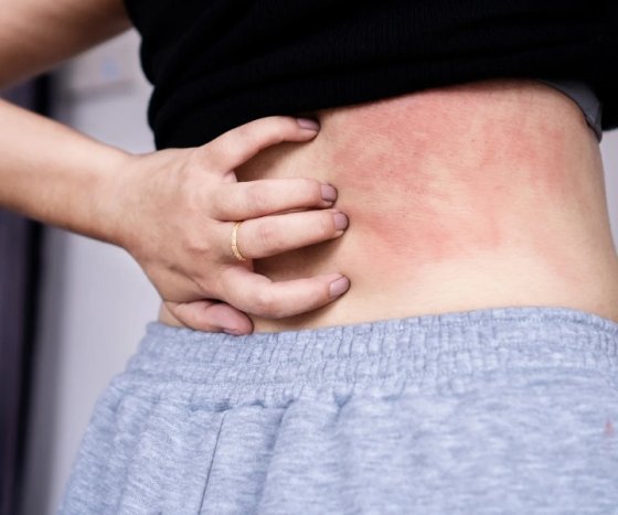 How to Get Rid of Rashes: Easy Home Remedies and Tips