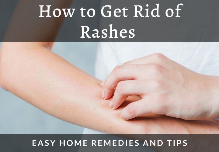 tips and home remedies to know how to get rid of rashes