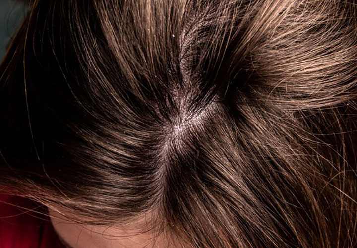 How to Get Rid Of Scalp Using Simple Tricks
