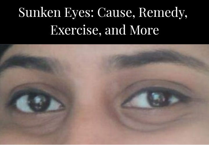 Sunken Eyes Causes Remedy Exercise and Many Other Tips