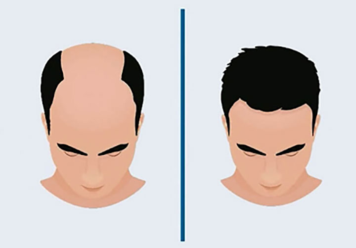 Best Hair Transplant Clinic in Roorkee Haridwar and Dehradun