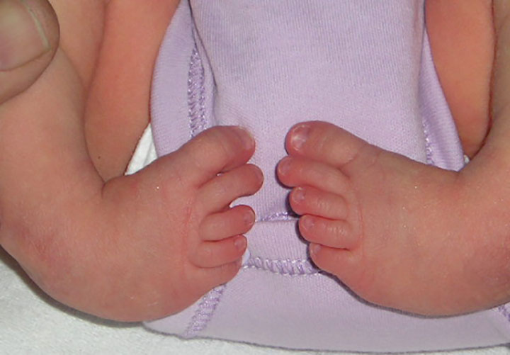 Orthopaedic Problem like Clubfoot is Common Among Children