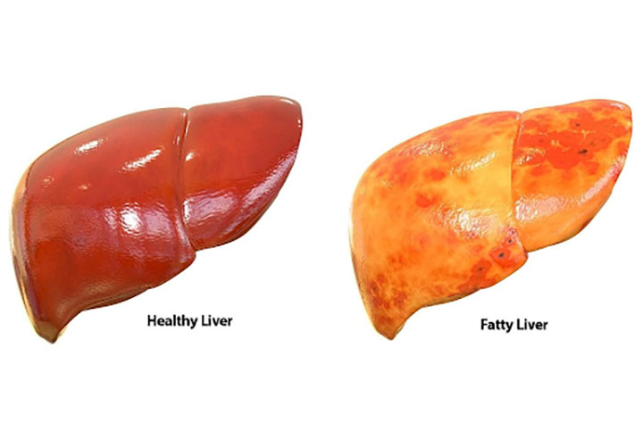 Comparison Between Fatty Liver and Normal Liver