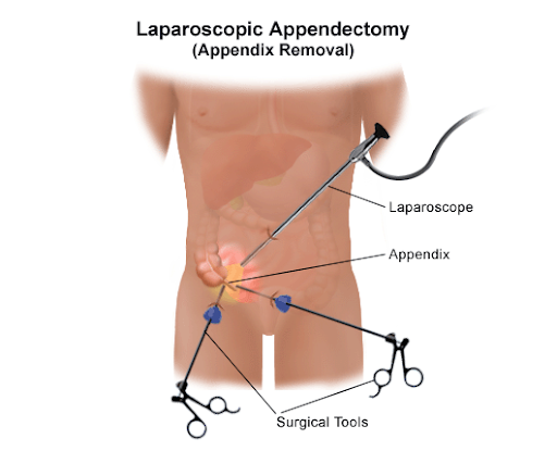 Diagram of Appendicitis Treatment