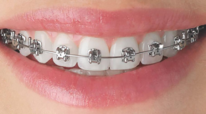 How Orthodontic Treatment Works