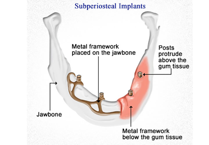 Subperiosteal implants are One Popular Dental Implants