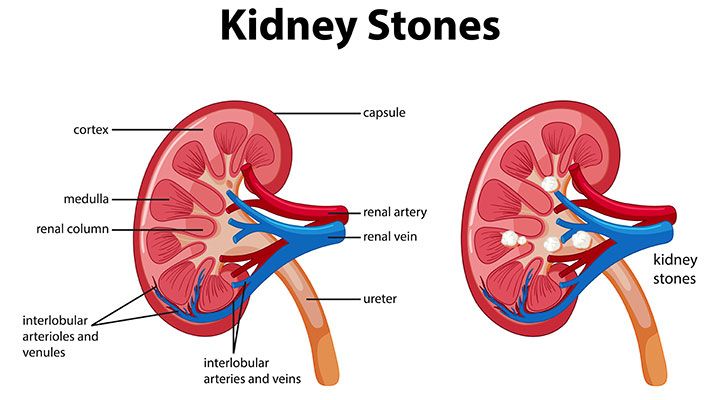 What are the Reasons Behind Kidney Stones