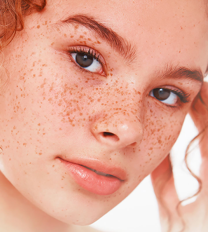 How Many Types of Hyperpigmentation is There