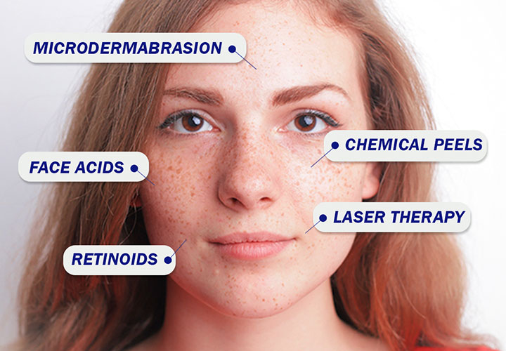 Know Everything about Hyperpigmentation