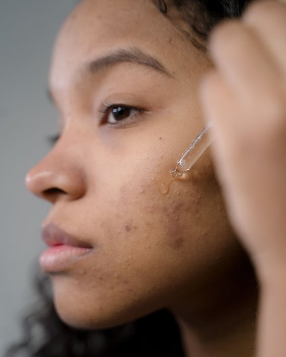 Salicylic Acid or Benzoyl Peroxide: What is Right for Acne