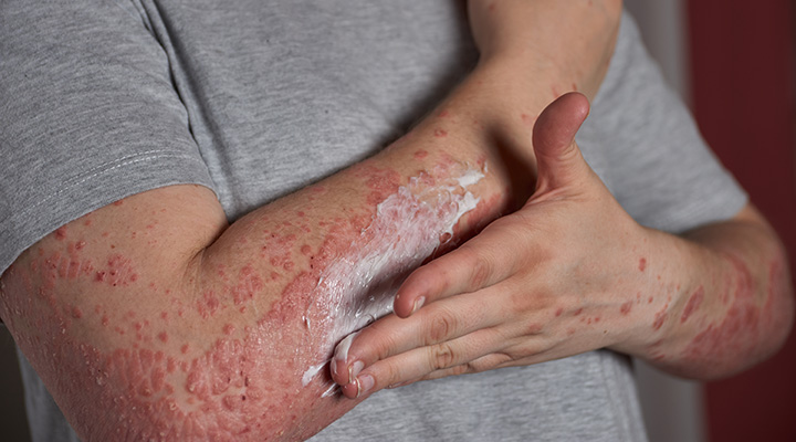 Psoriasis Causes, Remedies, Management, Treatments Available, and Ways to Stay Confident with Psoriasis