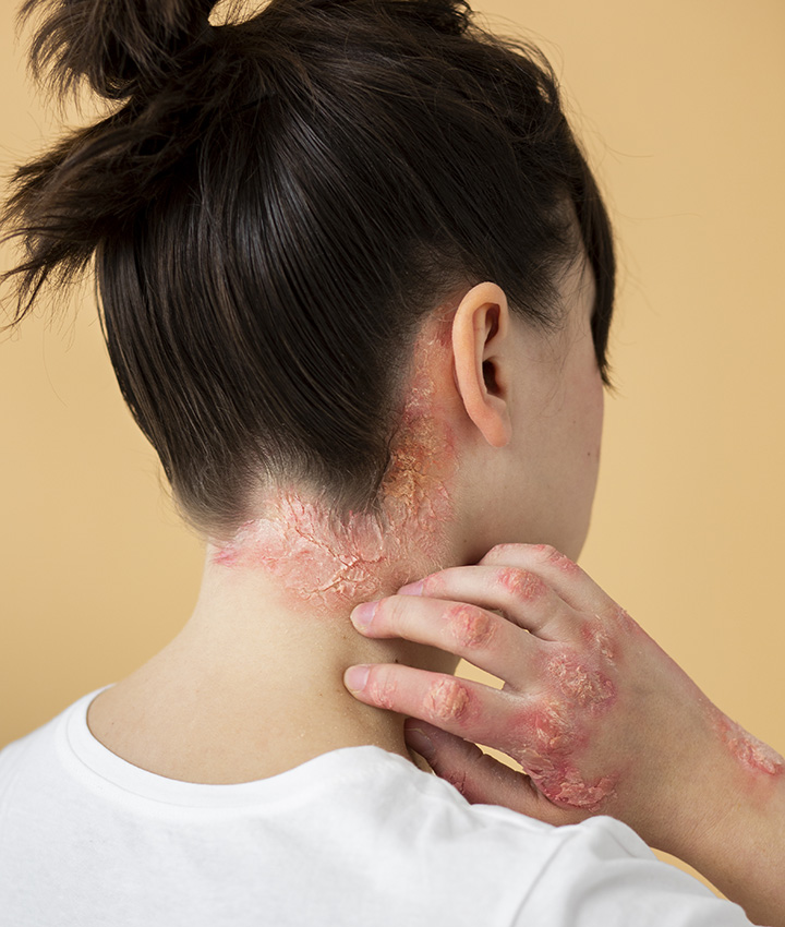 Psoriasis Triggers, Remedies, Management, and More